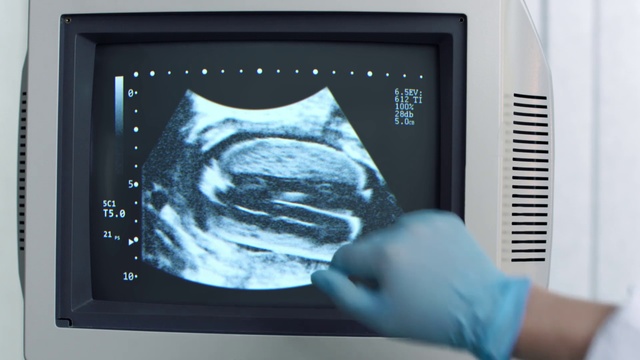 Video Reference: Screen, Obstetric ultrasonography, Medical, Radiology, Radiography, Television, Technology, Media, X-ray, Hand