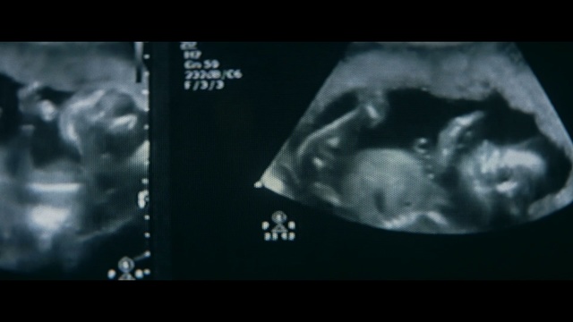 Video Reference: Medical imaging, Radiology, Radiography, Medical radiography, Medical, Organism, Darkness, Font, Monochrome photography, Jaw