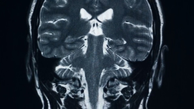 Video Reference: black and white, medical imaging, x ray, radiology, medical, medical radiography, radiography, darkness, computed tomography, organism, Person