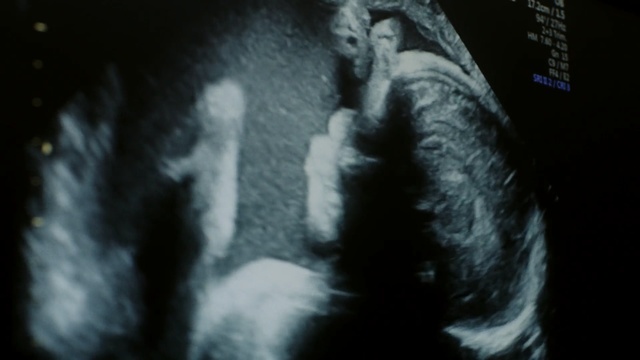 Video Reference: Black, Head, Darkness, Medical imaging, Monochrome photography, Human, Black-and-white, Jaw, Neck, Organism