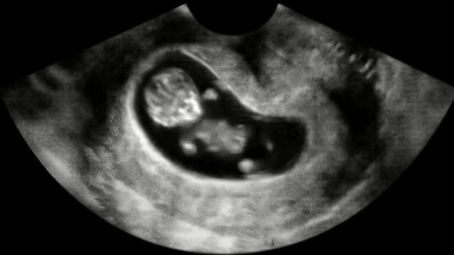 Video Reference: Obstetric ultrasonography, Medical imaging, Monochrome photography, Medical, Black-and-white, Mouth, Organ, Eye, Joint, Still life photography