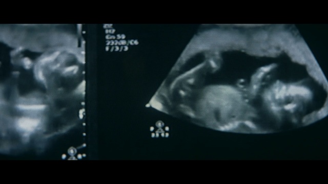 Video Reference: Medical imaging, Radiology, Radiography, Medical radiography, Medical, Organism, Font, Darkness, Monochrome photography, Jaw