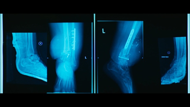 Video Reference: x ray, medical imaging, light, medical, radiology, radiography, joint, computer wallpaper, medical radiography, font