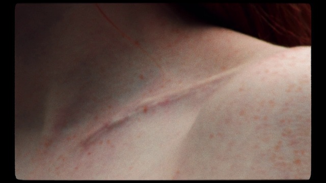 Video Reference: Skin, Scar, Flesh, Close-up, Neck, Joint, Hand, Pruritus, Muscle, Back