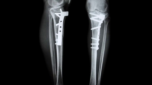 Video Reference: X-ray, Medical, Joint, Medical radiography, Radiology, Leg, Medical equipment, Radiography, Medical imaging