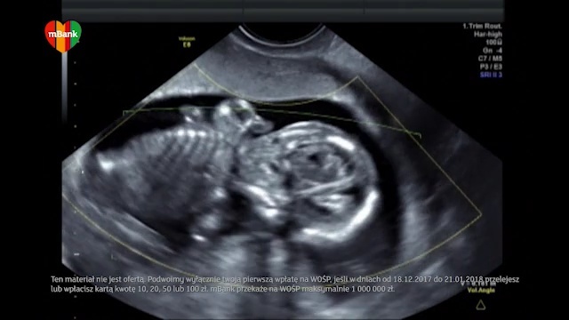 Video Reference: Medical imaging, Obstetric ultrasonography, Radiology, Medical, Medical radiography, Organ, Medical equipment, Service, Computed tomography, Organism