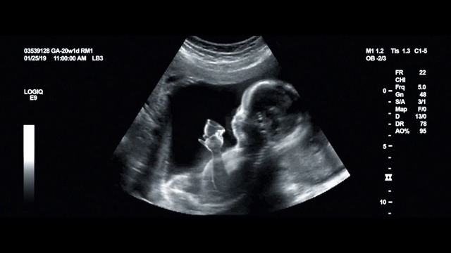 Video Reference: Medical imaging, Obstetric ultrasonography, Medical radiography, Medical, Radiology, Text, Joint, Monochrome photography, Font, Black-and-white