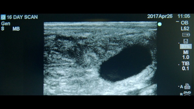 Video Reference: Medical imaging, Medical, Medical radiography, Radiology, Organism, Radiography, Screenshot, Screen