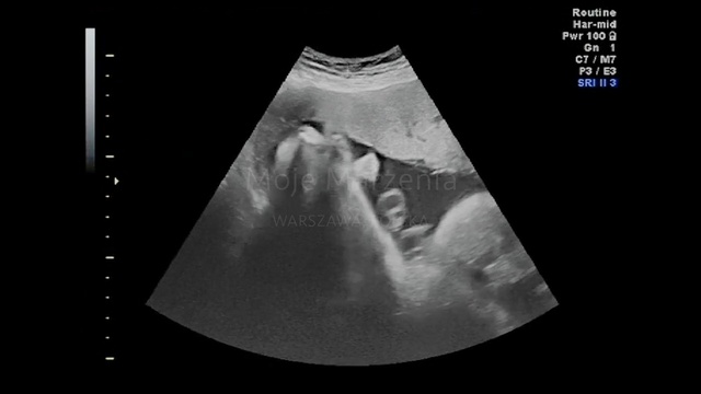 Video Reference: Obstetric ultrasonography, Medical imaging, Joint, Medical, Monochrome photography, Radiology, Black-and-white, Photography, Medical radiography