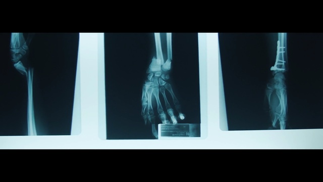 Video Reference: X-ray, Joint, Radiography, Radiology, Shoulder, Arm, Human body, Hand, Medical, Neck