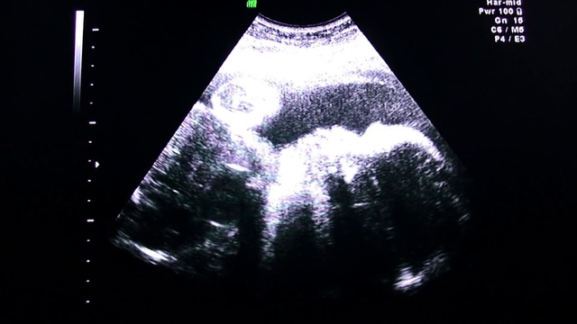 Video Reference: Obstetric ultrasonography, Medical imaging, Medical, Radiology, Service