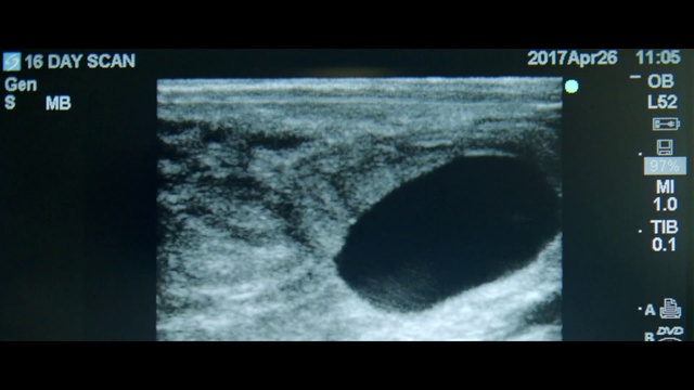 Video Reference: Medical imaging, Medical, Radiology, Medical radiography, Organism, Radiography, Technology, Screenshot, Photography, Multimedia