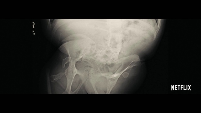 Video Reference: Radiography, Joint, Shoulder, Medical, Medical imaging, Radiology, X-ray, Medical radiography, Arm, Service