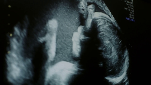 Video Reference: Black, Medical imaging, Head, Radiology, Nose, Darkness, Human, Jaw, Monochrome photography, Black-and-white