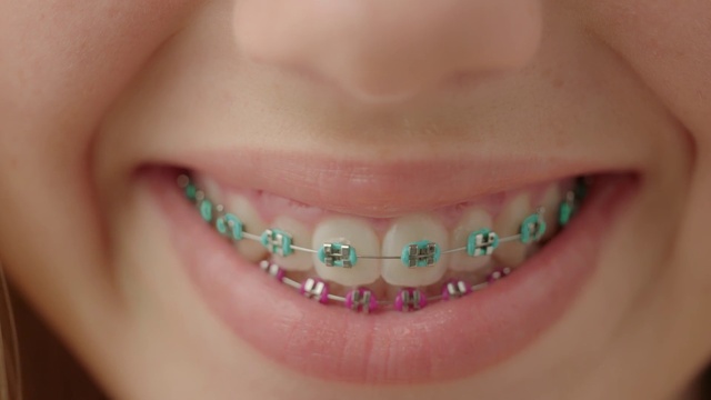 Video Reference: Nose, Skin, Lip, Chin, Smile, Dental braces, Mouth, Eyelash, Tooth, Body jewelry