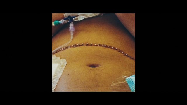 Video Reference: abdomen, surgery, stitches, incision, medical tubing, catheter, hospital, wound, postoperative, close-up, patient, medical care