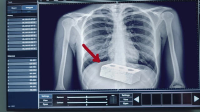 Video Reference: Joint, X-ray, Medical imaging, Radiography, Human body, Jaw, Medical, Radiology, Font, Service