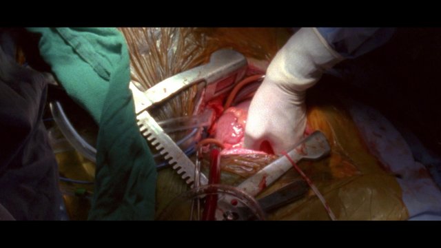 Video Reference: surgery, operating room, medical, surgeons, gloves, procedure, tissue, clamps, tools, hospital, close-up, clinical, anatomy, blood, medicine