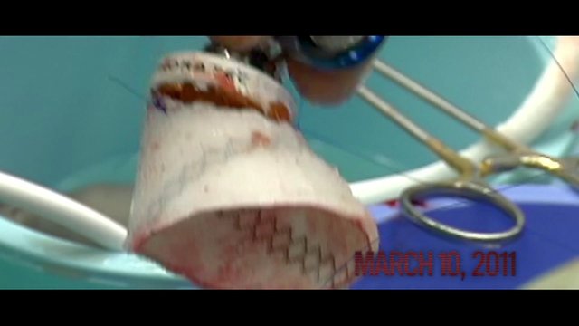 Video Reference: medical, surgery, blood, instrument, close-up, blurry, hospital, date stamp, equipment, procedure, surgical