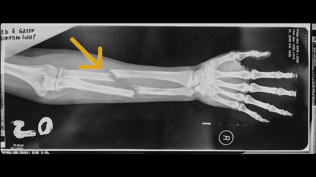 Video Reference: X-ray, Human body, Radiography, Font, Medical imaging, Bone, Medical, Service, Elbow, Event