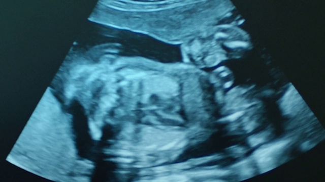 Video Reference: Human body, Jaw, Obstetric ultrasonography, Sleeve, Medical, Electric blue, Service, Darkness, Event, Art